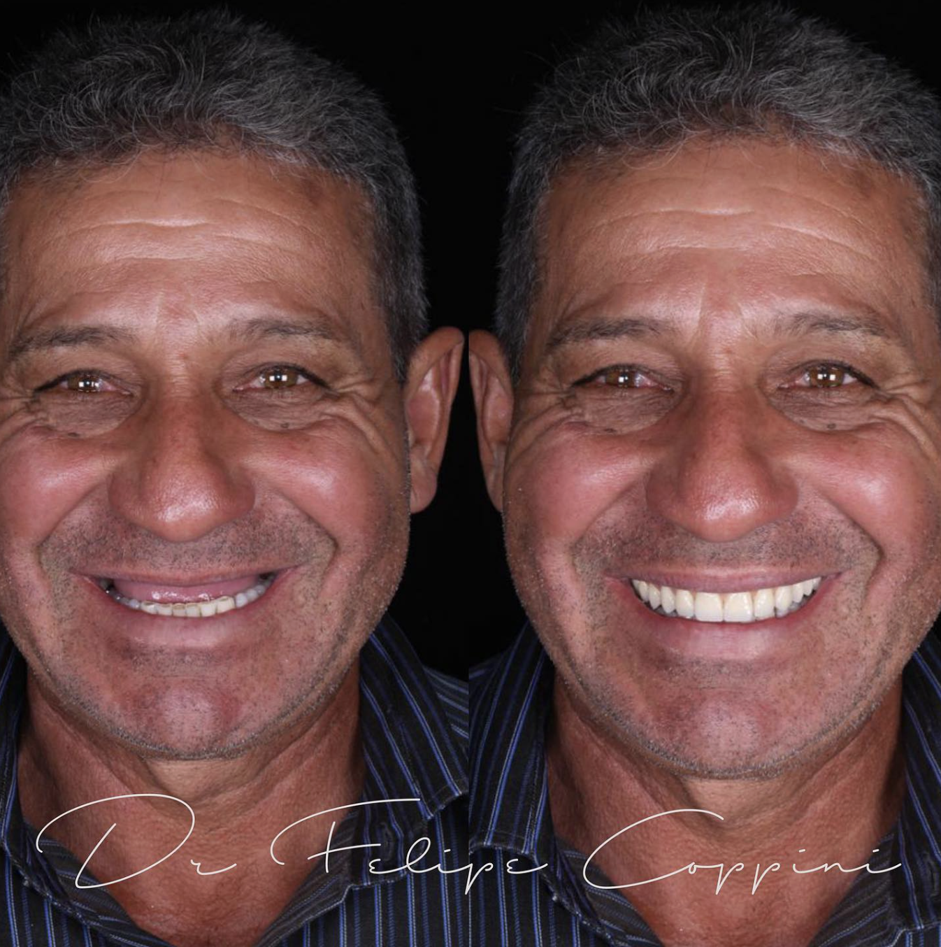 Antes e depois de tratamento odontológico realizado pelo Dr. Felipe Coppini — caso 3