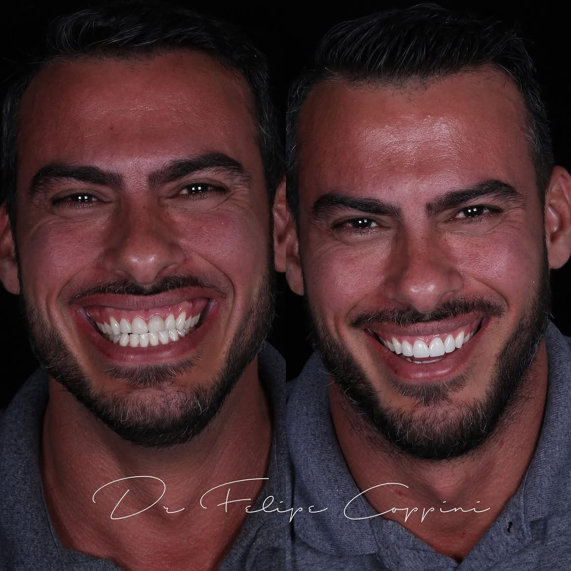 Antes e depois de tratamento odontológico realizado pelo Dr. Felipe Coppini — caso 1
