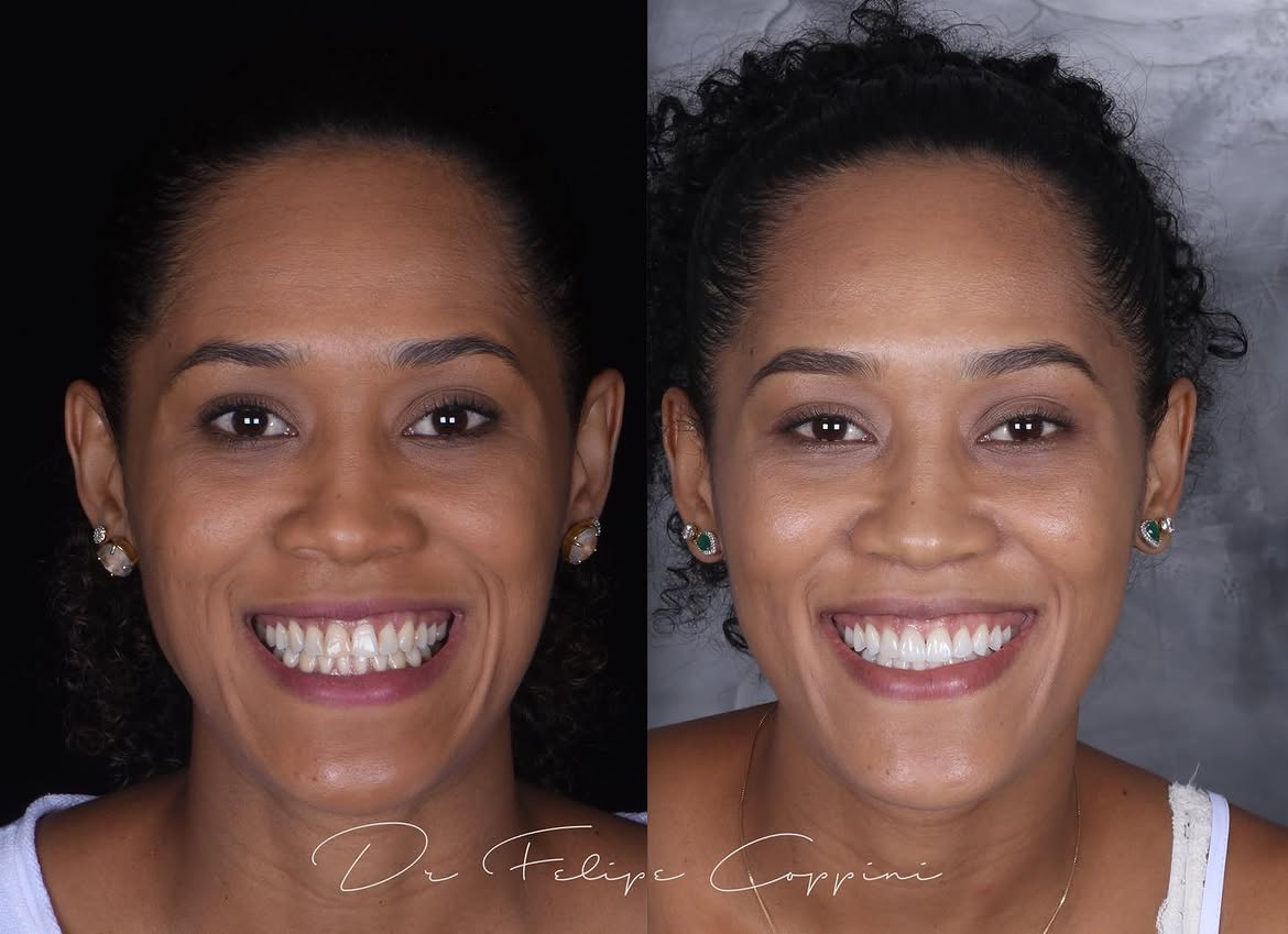 Antes e depois de tratamento odontológico realizado pelo Dr. Felipe Coppini — caso 2